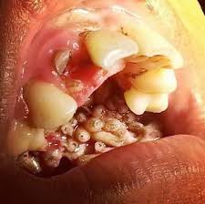 Meaning of myasis medical term. Myiasis Switzerland Pdf Ppt Case Reports Symptoms Treatment