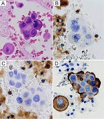 Stains for bap1 and mtap and p16 fish, for differentiating benign from malignant mesothelial. A Combination Of Mtap And Bap1 Immunohistochemistry In Pleural Effusion Cytology For The Diagnosis Of Mesothelioma Kinoshita 2018 Cancer Cytopathology Wiley Online Library