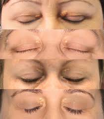 Image result for xanthelasma of eyelid