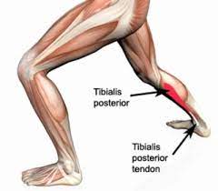 Tibialis Posterior Tendonitis Posterior Tibial Tendonitis Physioadvisor