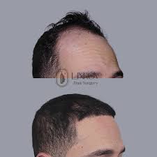 Image result for Alopecia