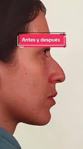 Transformación con rinoplastia por el Dr. William Becerra