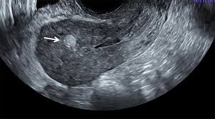 Ultrasound obstet gynecol sent rpoc. Retained Products Of Conception After Cesarean Section And Occult Placenta Accreta Mayo Clinic Proceedings