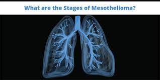 But the disease is rarer than other cancers, with only about 3,000 cases diagnosed in the u.s. The 4 Mesothelioma Stages Explained