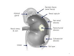 Image result for Perinephric Abscess