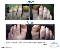 We did not find results for: 16 Foot Fungus Ideas Toenail Fungus Foot Fungus Athletes Foot