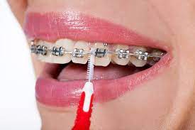 Metal or buccal braces) or lingual braces (aka: How To Brush Your Teeth With Braces The Wright Center For Orthodontics