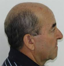 Particularities in the Surgical Technique of Calvaria Graft