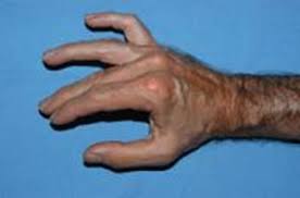Its really limiting my playing and i'm not sure what to do. Why Are My Ring Finger Pinky Finger Numb