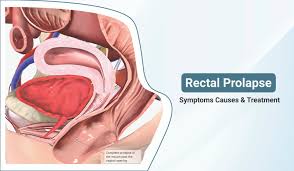 Image result for Rectal prolapse