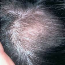 Low level laser therapy (lllt) is a new and innovative way to help in hair growth. Homogeneous Hair Growth After 11 Treatments With Excimer Laser Day Download Scientific Diagram