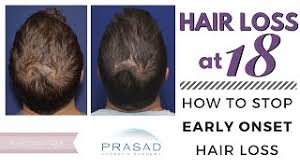 I'd say if your not taking any meds and your diet is good, go to the doctor and have your thyroid tested. Hair Loss At 18 A Better Treatment For Early Onset Hair Loss Than Prp Alone Youtube