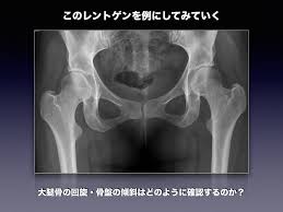 股関節 レントゲン 写真
