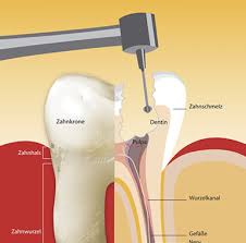 Was zahnärzte im detail machen und welche alternativen es gibt. Wurzelbehandlung Alternativen Gemeinschaftspraxis Dr Hofmann Steinwandt