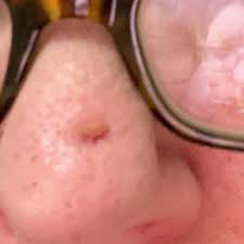 Image result for skin cancer on nose pimple