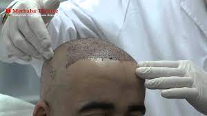 زراعة الشعر للرجال والنساء وتكلفة أفضل علاج للصلع بالتفاصيل إن زراعة الشعر في تركيا والسعودية ومصر أصبحت صيحة هذا العالم فستجد المهووسين بها في أغلب دول ال