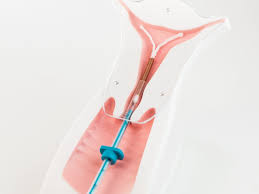 The strings should be protruding with your finger in place, feel around for your iud string. 8 Iud Myths You Need To Stop Believing