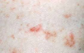 Image result for scabies bite