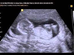Ultrasonido 14 Semanas 1 Youtube