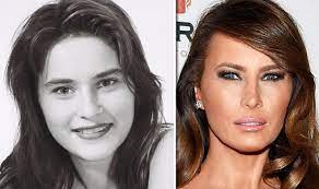Pictures of the first lady, which were taken when she was 17,. Melania Trump 12 000 Plastic Surgery Before And After Surgeon Comments On Possible Work Express Co Uk