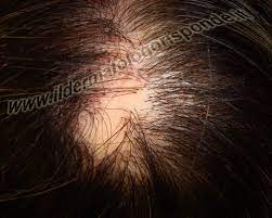 Salve,.premetto che ho 33 anni e ho sempre avuto folti capelli e con ricrescita veloce.in questa quarantena mi sono fatto una piccola ferita nel. Alopecia Areata In Dermatologia Come Riconoscerla Foto