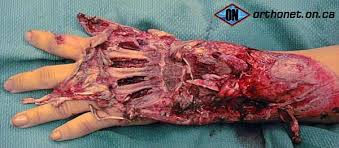 Résultat de recherche d'images pour "penis degloved"