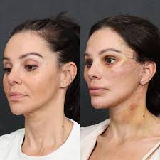 Here is my beautiful patient Jody 3 days after surgery. On day 3, we remove  surgical net sutures and little marks will disappear in couple days. She  had hybrid facelift and neck