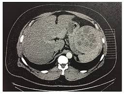 Mesothelioma is a type of cancer that starts . Unusual Radiologic Presentations Of Malignant Peritoneal Mesothelioma Abstract Europe Pmc