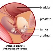 Breast cancer is the second most common cancer found in women — after skin cancer — but that doesn't mean men aren't at risk as well. Treatment For Prostate Cancer Gauri Urogynecology Clinic