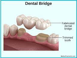 This can be affordable as dental insurance does help pay for tooth. Dental Crowns Bridges In Mexico Affordable Cost Quality Clinics