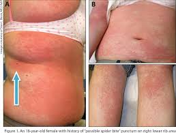 Petechiae are about pinpoint in size and they look like spots on the skin. Pdf Petechiae And Purpura The Ominous And The Not So Obvious Semantic Scholar