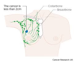 Stage 1 Breast Cancer Cancer Research Uk