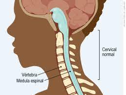 The ventral ramus of c5) to the plexus owing to its contribution to the formation of one of the motor branches of the cervical plexus called the. Cifosis Cervical Para Padres Nemours Kidshealth