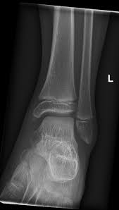 Image result for Ankle XRay