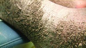 The main treatment for primary biliary cirrhosis is to slow liver damage with the drug ursodiol (actigall, urso). Keys To Diagnosing And Treating Xerotic Skin Conditions