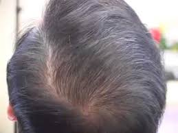 Still, this doesn't mean that those of asian heritage do not experience hair loss; Asian Crown Vertex Restoration Video Youtube
