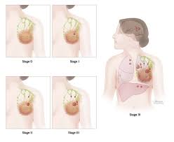 Staging Grade Breast Pathology Johns Hopkins Pathology