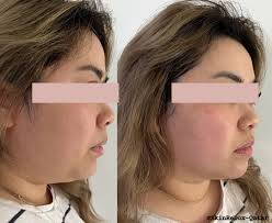 7D HIFU + RF Ultra Facelift & V-Shape Treatment✨️ An incredible combination  to snatch that jawline! Package inclusions: 1 session 7D HIFU Lower face  (Cheek & double chin) 5 sessions RF Ultra