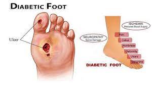 The good news is that some simple changes can help to. Diabetes And Poor Circulation Imtiyaz I Kapadwala Dpm Podiatry Vascular Specialist In Brooklyn Ny Youtube