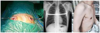 Image result for Flail Chest