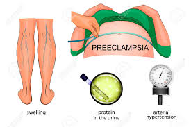 Los Sintomas De Preeclampsia Durante El Embarazo Hinchazon De Los Pies La Hipertension Arterial Y Proteina En La Orina Ilustraciones Vectoriales Clip Art Vectorizado Libre De Derechos Image 58384541