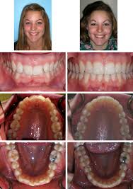 Check spelling or type a new query. Invisalign Braces In Ebensburg Pa Joseph Cavalier Dmd
