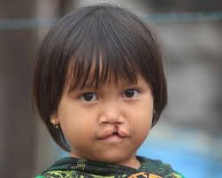 Image result for Cleft Lip