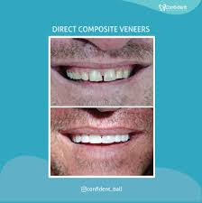 The skill and experience of your dentist who applies your veneers is crucial when it comes to predicting how long your veneers will last. Confident Bali Dental Clinic Best Dentist In Bali