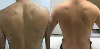 • laser hair removal is much more precise due to the use of monochromatic light which is easily absorbed by melanin. Laser Hair Removal Russak Aesthetic Centre New York City Ny