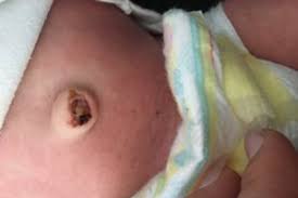 Ich habe hier 5 katzenbabys. Bauchnabel Abgefallen Forum Frag Unsere Hebamme Urbia De