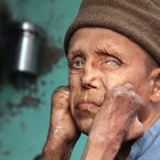 Lepra currently works in india, bangladesh, zimbabwe and mozambique. Lepra Die Unheimliche Krankheit Lebt Welt Lepra Tag Am 31 Januar Gesundheit