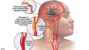 Maka dari itu, ia menjelaskan infeksi jamur hitam lebih tepat disebut dengan jamur yang menyebabkan kelainan berwarna hitam. Stroke Saat Pembuluh Darah Otak Tersumbat Health Liputan6 Com