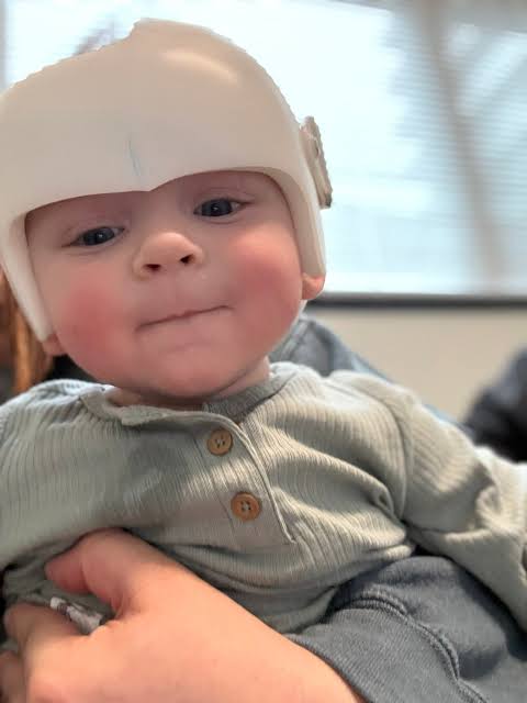Baby completes cranial molding treatment ahead of schedule