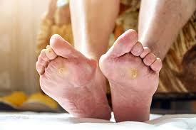 Image result for diabetic toes